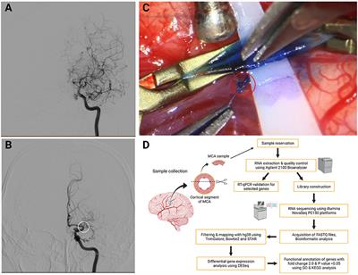 Transcriptomic Profiling of Intracranial Arteries in Adult Patients With Moyamoya Disease Reveals Novel Insights Into Its Pathogenesis